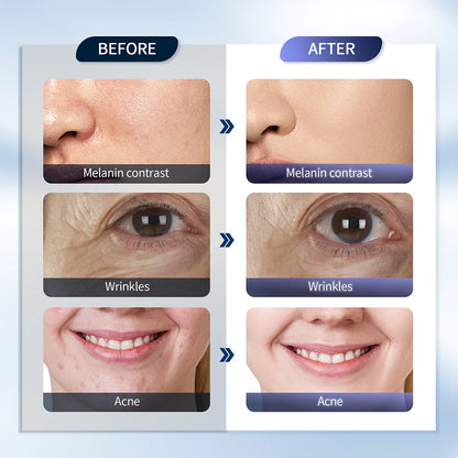 Foreverlily LED Maska – 7 Farieb Fotónová Terapia s Nano Sprejom